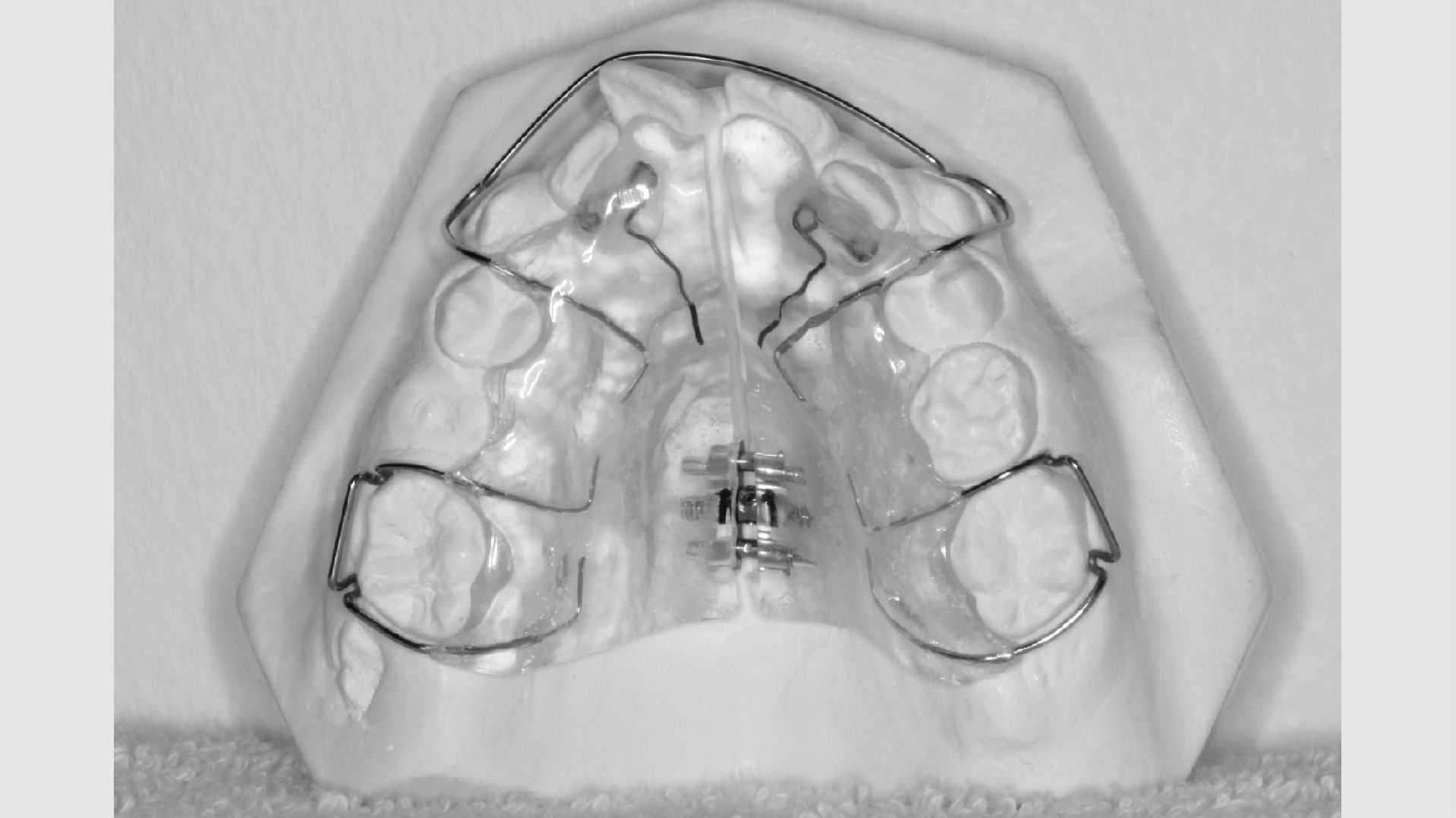 Ganebøjle på gips gebis