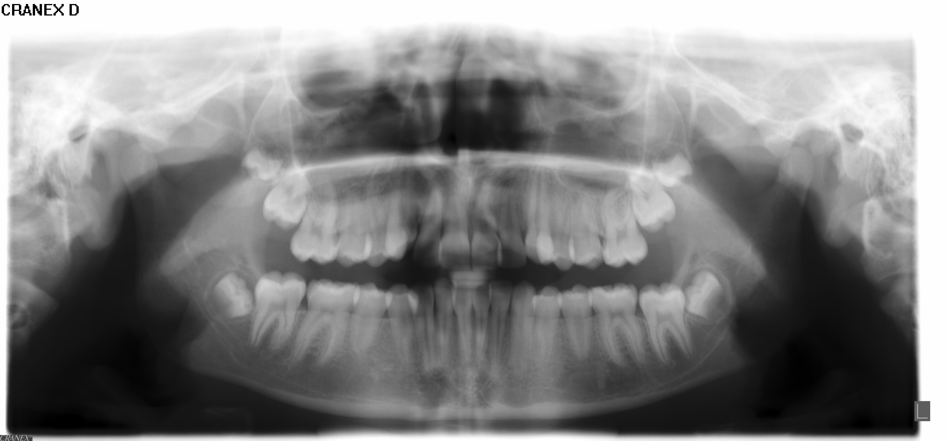 Røntgenbillede af tænder